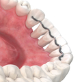 prime4me® PERIO3R maxilla 0,55 mm