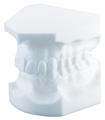 Orthodontic study model, Angle Class II/1