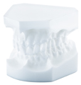 Orthodontic study model, Angle Class II/2